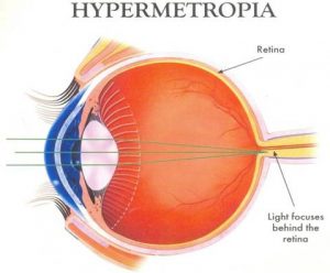 Hypermetropia – Ďalekozrakosť