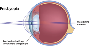 Presbyopia – starecké videnie
