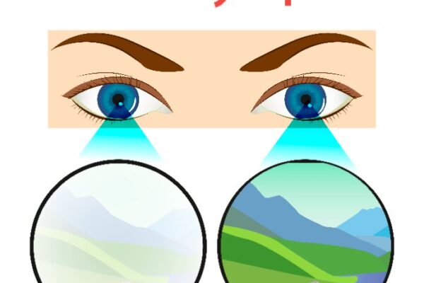 Amblyopia – Tupozrakosť