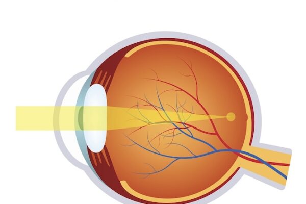 Myopia – Krátkozrakosť